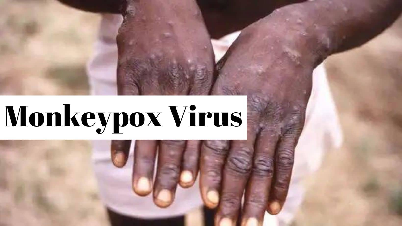 Monkeypox Mutating Faster Than Thought: 7 Warning Symptoms You Should Never Ignore
